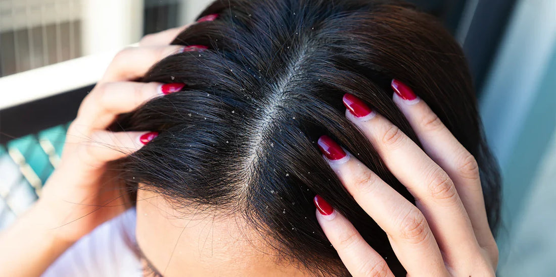 Dandruff: Proven Causes, Effective Treatments, and Expert Prevention Tips